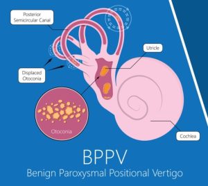 Read more about the article Minden, amit tudni kell a BPPV-ről