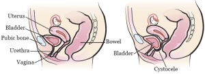 Read more about the article Cystocele: Mi is az, és mit jelent?