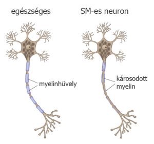 Read more about the article Minden, amit tudnod kell a demyelinizációról
