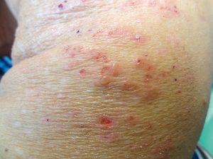 Read more about the article Minden, amit tudni kell a dermatitisről