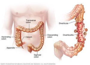 Read more about the article Minden, amit tudnod kell a diverticulosisról