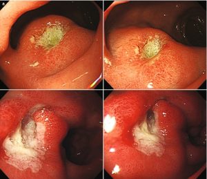 Read more about the article Minden, amit tudnod kell a duodenitis-ről