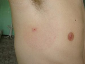 Read more about the article A Lyme-folt mikor jelenik meg és hogyan ismerheted fel
