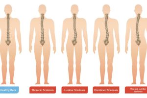 Read more about the article A Scoliosis: Mit Jelent és Hogyan Kezelhető?