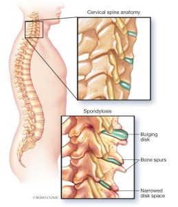 Read more about the article Minden, amit tudni kell a spondylosis-ról