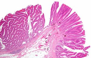 Read more about the article Adenoma Tubulare: Mi is Pontosan?