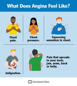 Read more about the article Minden, amit tudni kell az angina pectoris-ról