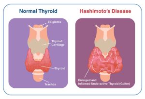 Read more about the article Autoimmun Thyreoiditis: Mi is Pontosan?