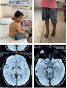 Read more about the article Axiális Hypotonia: Mi is Pontosan Jelenti?
