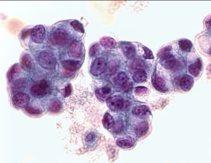 Read more about the article Minden, amit tudni kell az adenocarcinomáról