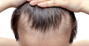 Read more about the article Minden, amit tudni kell az alopeciáról