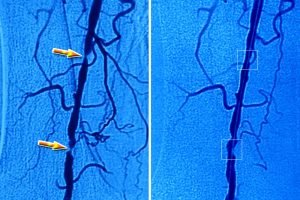 Read more about the article Angiográfia: Mi is pontosan ez és miért fontos?