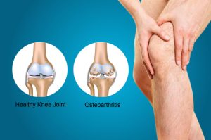 Read more about the article Minden, amit tudni kell az arthrosis-ról