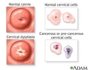 Read more about the article Minden, amit tudni kell a cervicalis dysplasiáról