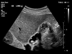 Read more about the article Minden, amit tudnod kell a cholecystae cholesterolosisról