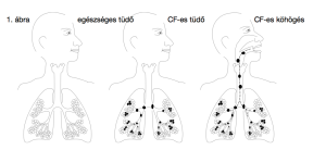 Read more about the article Mindent a cisztás fibrózisról: Mi is ez valójában?