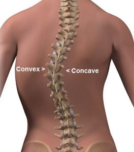 Read more about the article Balra Convex Scoliosis: Mi Jelent és Hogyan Kezelhető?