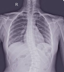 Read more about the article Convex Torsios Scoliosis: Mi is pontosan ez és mit jelent?