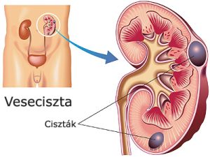 Read more about the article Minden, amit tudnod kell a corticalis cysta jelentéséről