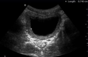 Read more about the article Cystitis Acuta: Mi is Pontosan Ez?