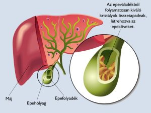 Read more about the article Cholelithiasis: Mi is Pontosan?