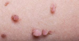 Read more about the article Mit jelent a HPV gyanú?