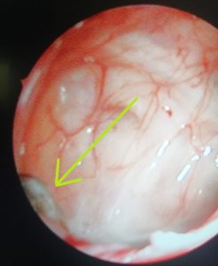 Read more about the article Minden, amit tudnod kell a sinusitis maxillaris acuta-ról