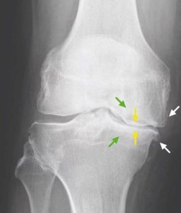 Read more about the article Subchondralis sclerosis – Mit jelent és hogyan kezelhető?