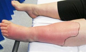 Read more about the article Mindent a Cellulitisről – Mit Jelent és Hogyan Kezelhető?