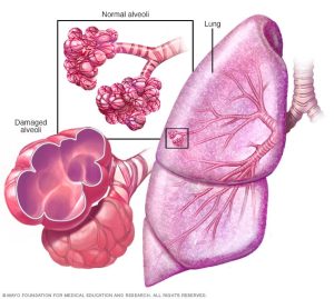 Read more about the article Minden, amit tudni kell a COPD-ről