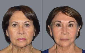 Read more about the article Minden, amit tudni kell a facelift-ről