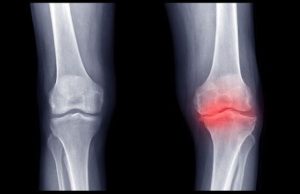 Read more about the article Minden, amit tudni kell a gonarthrosis-ról