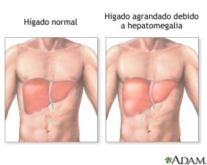 Read more about the article Minden, amit tudni érdemes a hepatomegáliáról