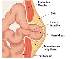 Read more about the article Herniák: Mi is pontosan a hernia és hogyan kezelhető?