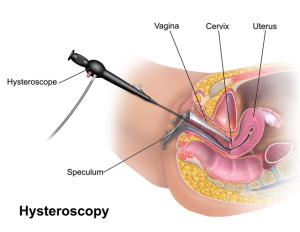 Read more about the article Minden, amit tudnod kell a hysteroscopia-ról