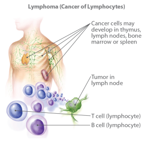 Read more about the article Lymphoma – Mindent, amit tudni kell