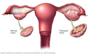 Read more about the article Mindent, amit tudni kell a PCOS-ról