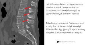Read more about the article Schmorl-benyomat: Mi is ez valójában?