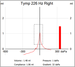 Read more about the article Tympanogram: Mindent, amit tudni kell