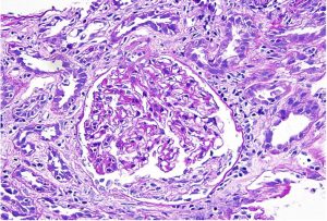 Read more about the article Akut Tubulo-Interstitialis Nephritis: Mit Jelent?