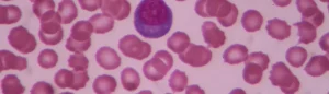 Read more about the article Az Alacsony Lymphocyta Szint és Jelentősége