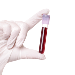 Read more about the article Minden, amit tudni kell az Anti-Streptolizin O-ról