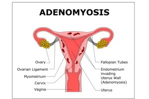 Read more about the article Adenomyosis – Minden, amit tudni kell erről a problémáról