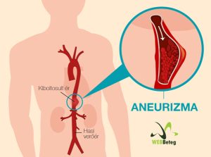 Read more about the article Aneurysma: Mindent, amit Tudni Kell Erről a Veszélyes Állapotról
