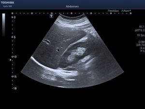 Read more about the article Angiomyolipoma – A veszélytelen daganat