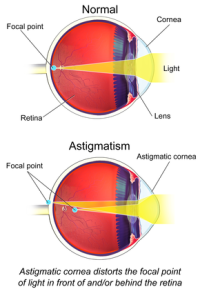 Read more about the article Áttekintés az Astigmatismusról