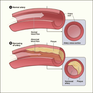Read more about the article Atherosclerosis: Mi is pontosan ez a betegség?