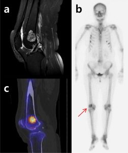 Read more about the article Mindent, amit tudni kell az enchondroma-ról