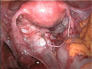 Read more about the article Minden, amit tudni kell az endometriózisról