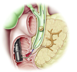 Read more about the article Minden, amit tudnod kell az ERCP-ről